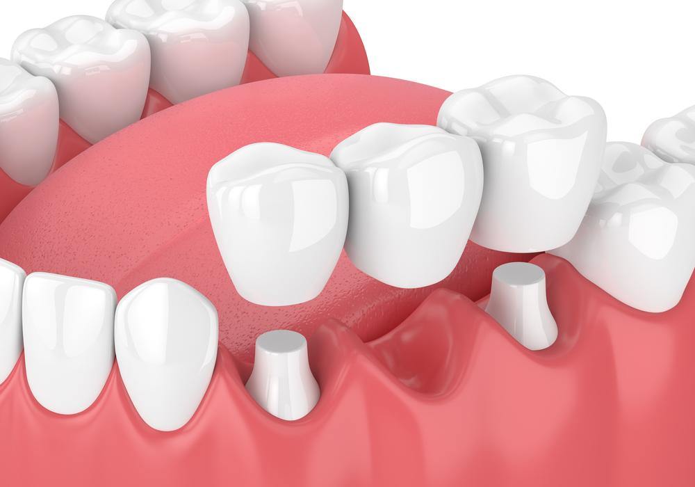 Crown & Bridge - 3Z Dental