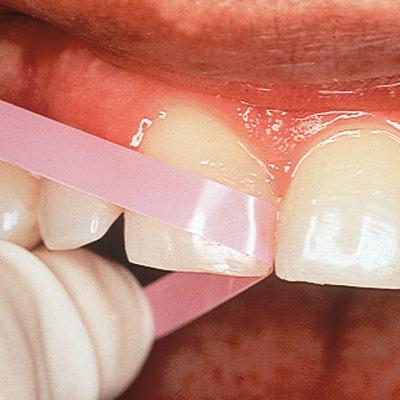 Super-Snap® Polystrips, 100/Pkg