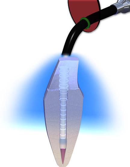 EZ-Fit Translucent - 3Z Dental