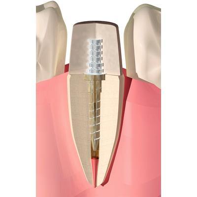 Flexi-Flange® Post System – Introductory Kit - 3Z Dental