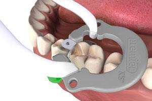 Premier® X5 Sectional Matrix System™ - Matrix Refills - 3Z Dental