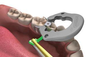 X5 Sectional Matrix System Kits - 3Z Dental