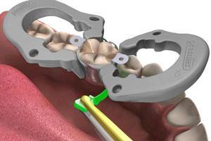 X5 Sectional Matrix System Kits - 3Z Dental